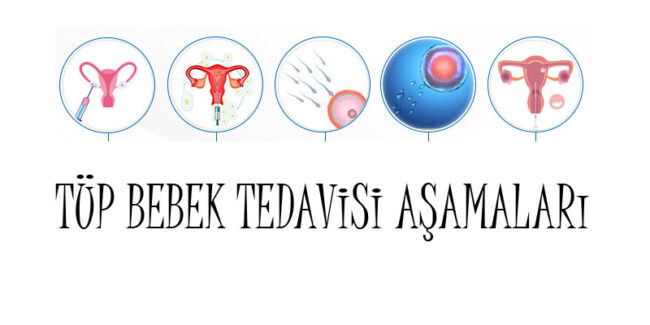 tup-bebek-tedavisi-asamalari